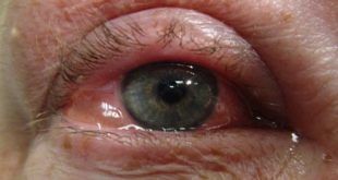 Juckende-Augen-Ursachen-Gesundheit